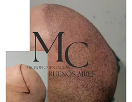 Micropigmentacion Buenos Aires / micropigmentacion capilar